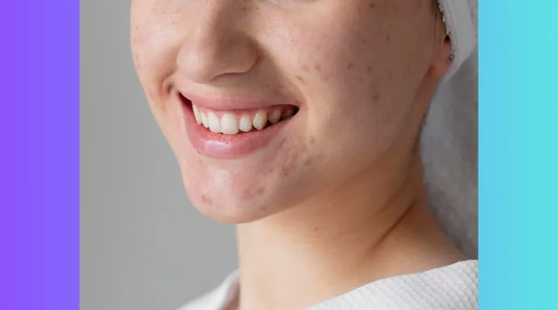 Yang Perlu Kamu Tahu Untuk Menghilangkan Jerawat Selamanya